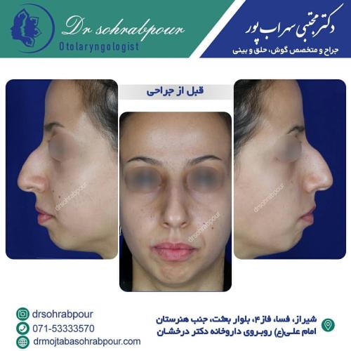 جراحی-بینی-در-شیراز200
