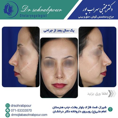 جراحی-بینی-در-شیراز201