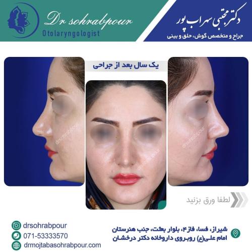 جراحی-بینی-در-شیراز202