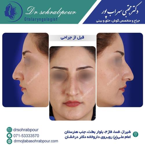 جراحی-بینی-در-شیراز203