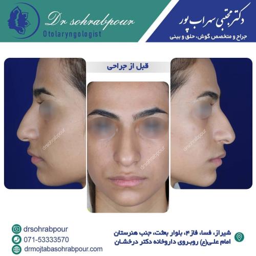 جراحی-بینی-در-شیراز204
