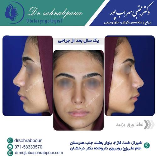 جراحی-بینی-در-شیراز205