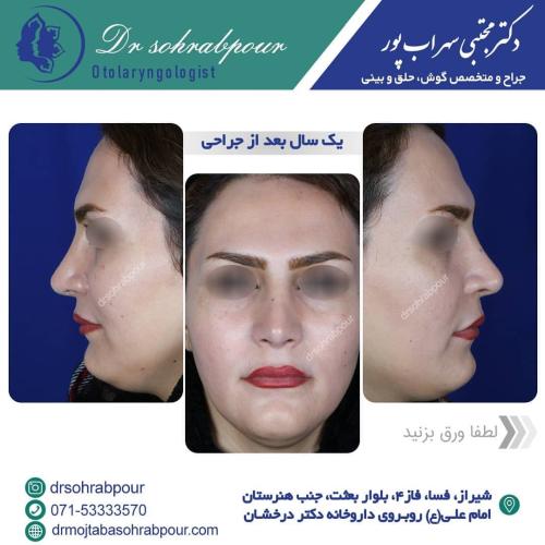 جراحی-بینی-در-شیراز206